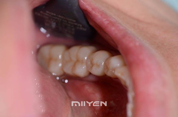 UT كتلة زركونيا الأسنان متعددة الطبقات